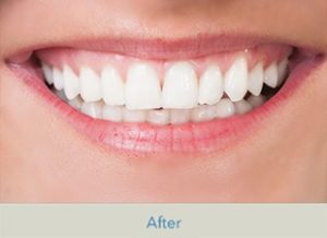 cosmetic_dentistry_Delray_Beach