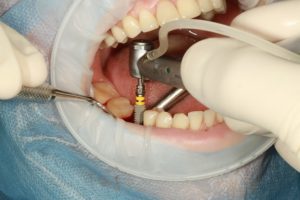 dental_implants_delraybeachfl