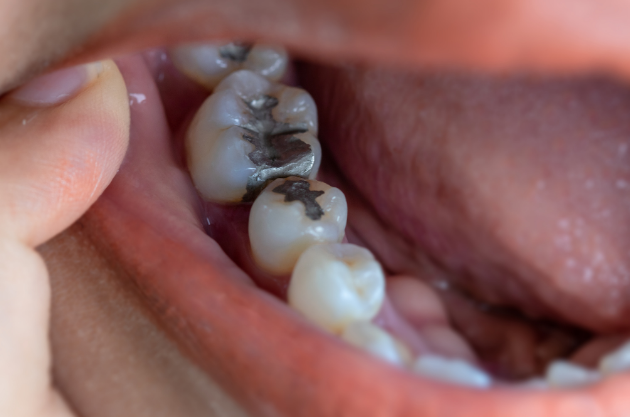 Mercury_Free_Dentistry