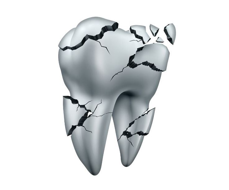 silver_amalgam_fillings_removal_dentist