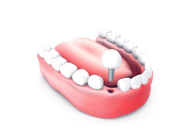 missing_teeth_dental_implants_dentist_Delray_Beach